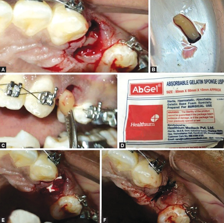 Evaluation of Efficacy of Advanced Platelet-rich Fibrin in Premolar Extraction Sockets as an Aid to Accelerate Orthodontic Tooth Movement and Wound Healing: A Split-mouth <i>In Vivo</i> Study.