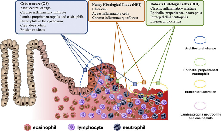 Mucosal Healing of Ulcerative Colitis Based on Endoscopic Diagnosis, Histopathology, and Mucosal Inflammatory Mediators.
