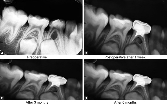 Comparative Clinical and Radiographic Evaluation of Three Different Herbal Extracts in Combination with Calcium Hydroxide as Obturating Materials in Primary Teeth: An <i>In Vivo</i> Study.