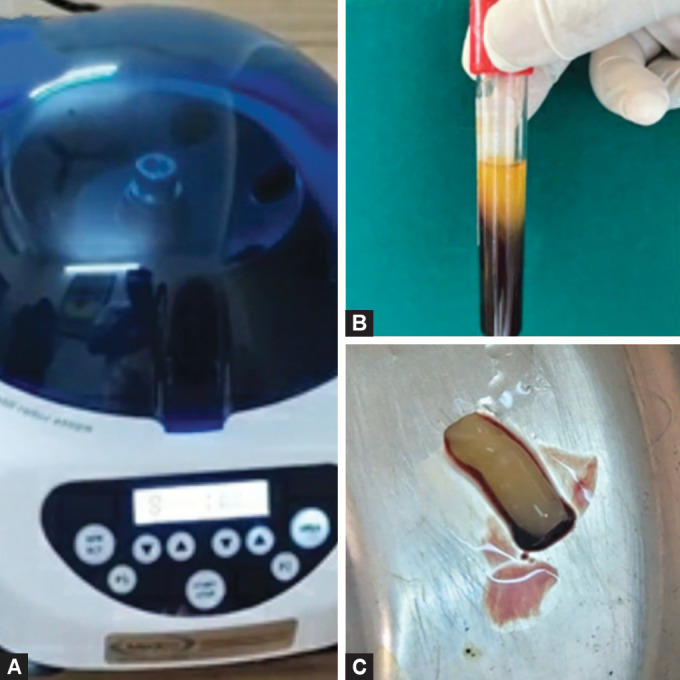 Evaluation of Efficacy of Advanced Platelet-rich Fibrin in Premolar Extraction Sockets as an Aid to Accelerate Orthodontic Tooth Movement and Wound Healing: A Split-mouth <i>In Vivo</i> Study.