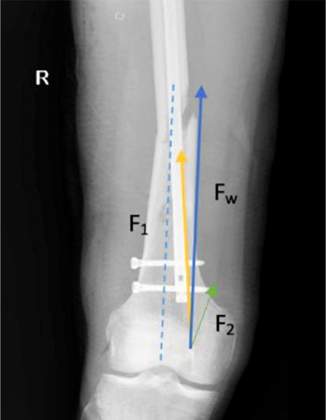 Evaluation of the effect of eccentric nailing on femoral diaphyseal union delay.