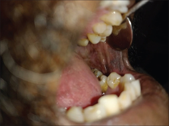 Emmprin (CD147) expression in oral submucous fibrosis and in oral squamous cell carcinoma-A potential predictor.