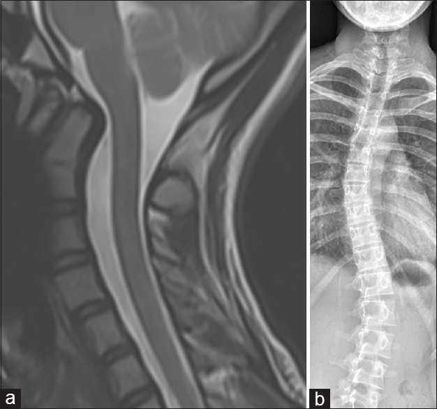 Assessment of posterior odontoid tilt: Think scoliosis.