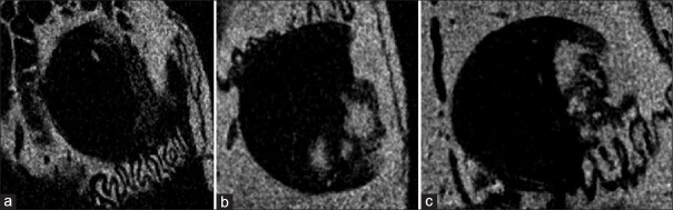 Osteogenic effects of metformin and exenatide on bone regeneration in non-diabetic rats: A Micro-CT and histological study.