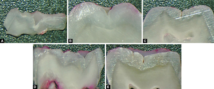 Efficacy of Ion-releasing Pit and Fissure Sealants Compared with Other Modified Pit and Fissure Sealants when Subjected to Heat and Ultrasonic Vibration: An <i>Ex Vivo</i> Comparison.