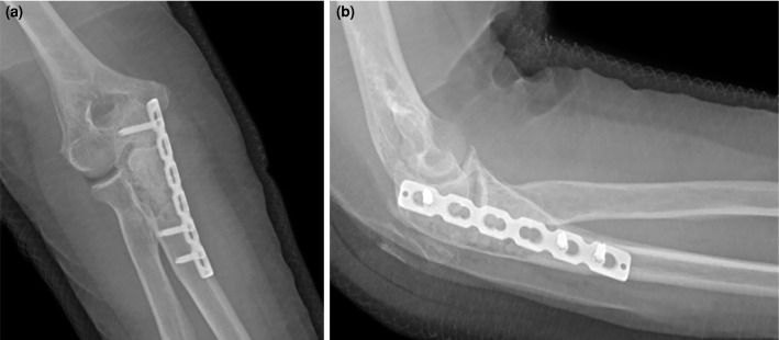 Intraosseous schwannoma of the olecranon: A case report.