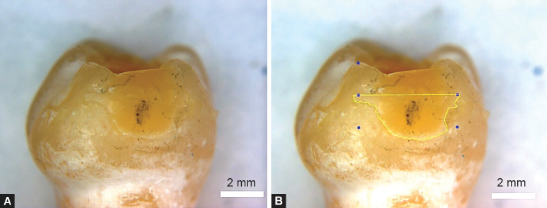 <i>In Vitro</i> Evaluation of Contact Tightness and Marginal Overhang in Class II Primary Molar Restorations Restored with Different Matrix Systems.