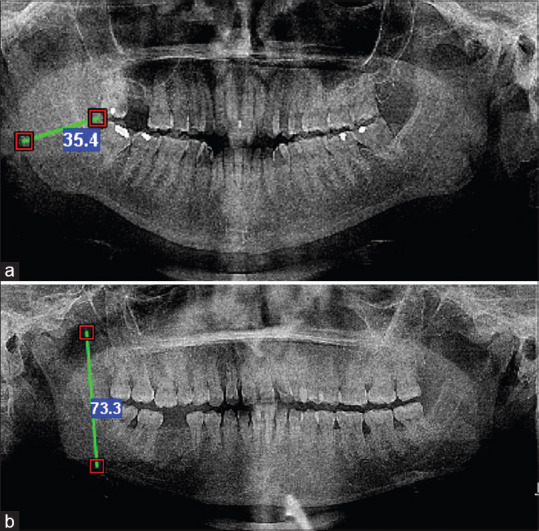 Minimum ramus breadth and coronoid height in gender determination - An orthopantomographic study.