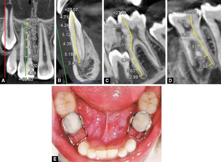 Familial, Nonsyndromic, Generalized Radiculomegaly Affecting Both Dentitions: The First Reported Case.