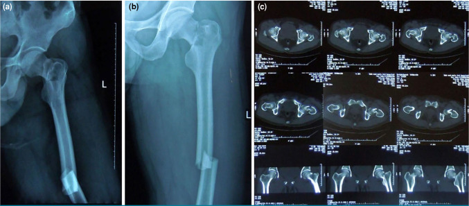 Percutaneous joystick reduction with reductor-T tape pin and fixation with a reconstruction nail for the treatment of ipsilateral femoral neck and shaft fractures.