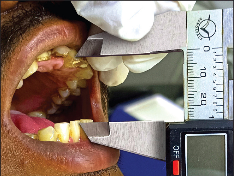Evaluation of the effectiveness of oral Pirfenidone in the treatment of oral submucous fibrosis: A non-randomised pilot clinical trial.