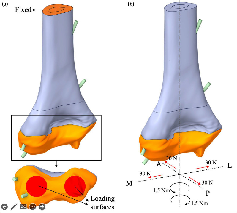 Effect of fracture level on optimal Kirschner wire configuration in pediatric supracondylar humerus fractures: A finite element analysis.