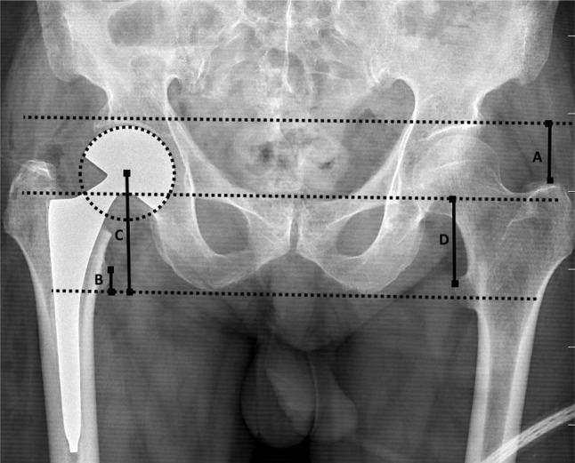 Radiographic acetabulotrochanteric distance measurement as a novel method for determining leg length discrepancy in patients with hemiarthroplasty.