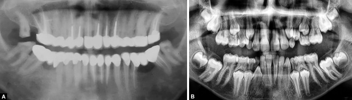 Familial, Nonsyndromic, Generalized Radiculomegaly Affecting Both Dentitions: The First Reported Case.