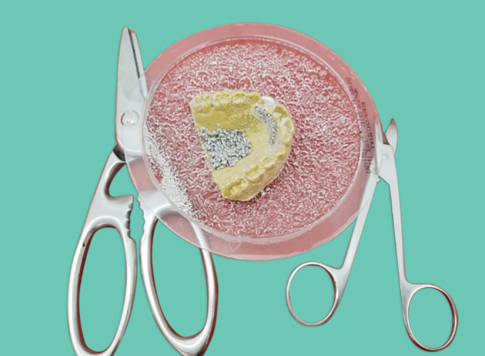 Tongue Retraining Appliance: Clear Tongue Crib and Clear Tongue Cage Appliance.