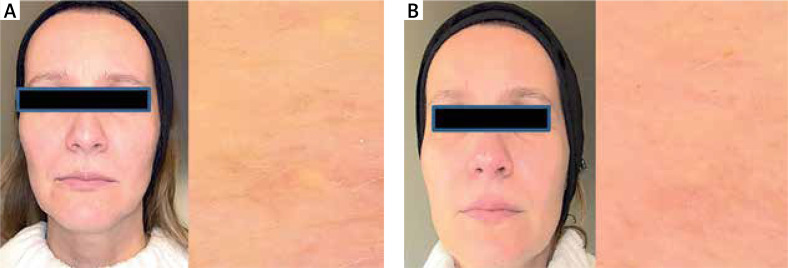 Effects of antioxidant-anti-inflammatory therapy on skin rejuvenation and repair. The clinical case series study.