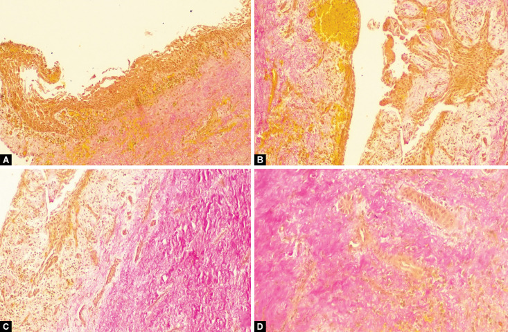 Pediatric Surgical Management of Cystic Ameloblastic Fibroma-Mural Type: A Rare Enigmatic Pathology.