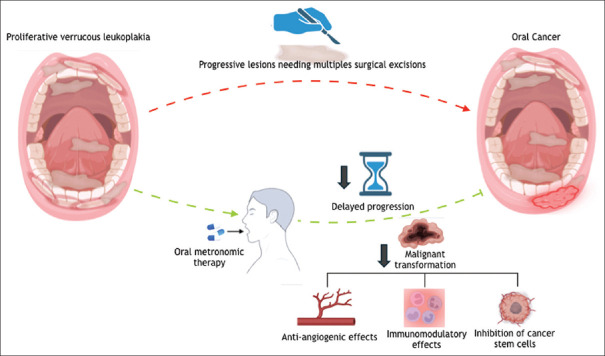 Optimizing outcomes: The role of oral metronomic therapy in proliferative verrucous leucoplakia.