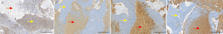 [Metaplastic carcinoma of the breast with heterologous mesen-chymal (neuroectodermal) differentiation: a clinicopathological analysis and literature review].