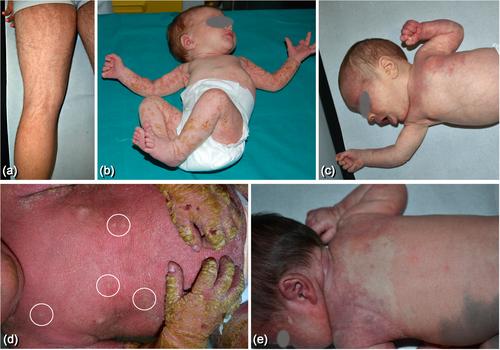 Clinical Classification of Mosaicism