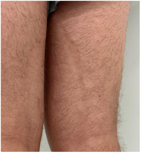Pigmentary Mosaicism: An Overview