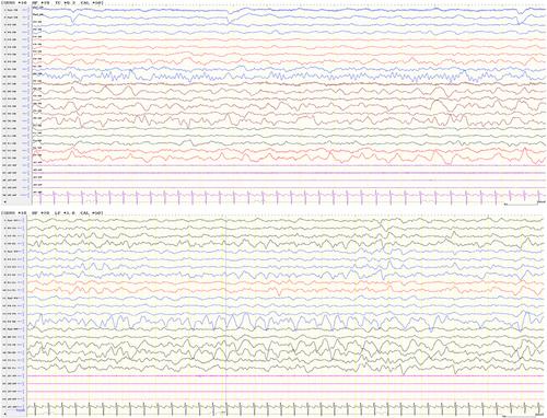 Moyamoya Syndrome, Epilepsy and Hydrocephalus in Neurofibromatosis Type 1