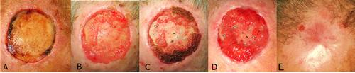 Successful Use of Combined Fractional Laser Resurfacing for Deep Scalp Defect