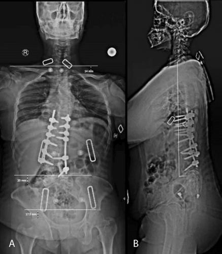 The Role of 3D Printed Spine Model in Complex Spinal Deformity Surgery; an Experience With a Case, Technical Notes and Review of the Literature