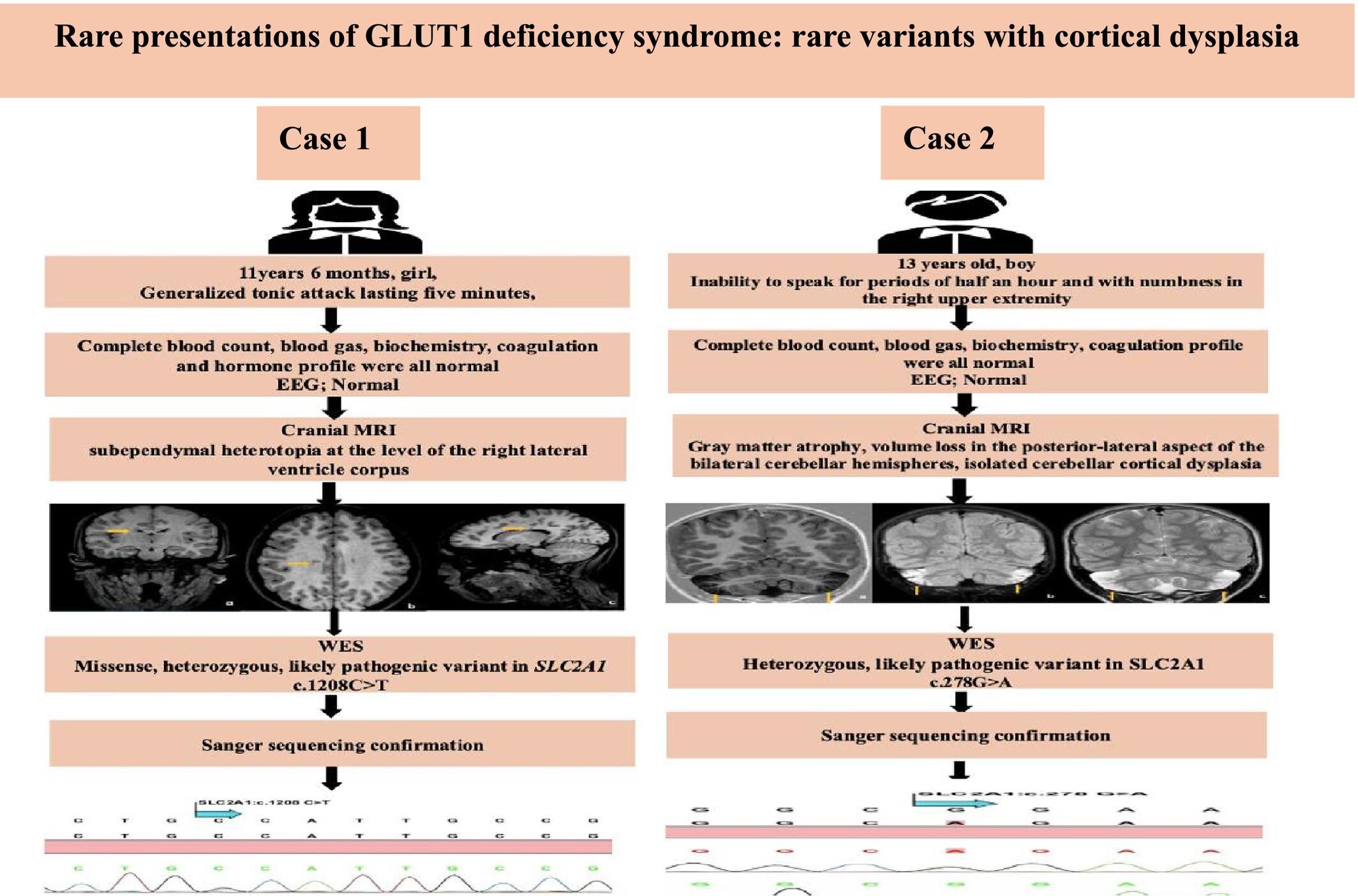 Rare Presentations of GLUT1 Deficiency Syndrome: Rare Variants With Cortical Dysplasia in Two Unrelated Families