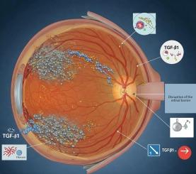 Effect of cytokine TGF-β1 on pathological changes in diabetic retinopathy