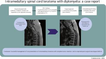 SPINAL CORD TERATOMA WITH DIPLOMYELIA