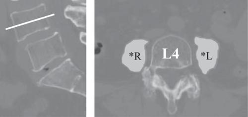 Association of spinopelvic mobility and osteosarcopenia with total hip arthroplasty outcomes
