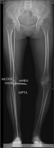 Restoring prearthritic alignment improves joint perception in medial unicompartmental knee arthroplasty