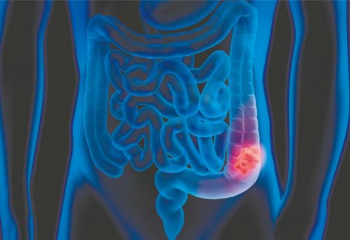 Decoding the mysterious surge in early-onset colorectal cancers