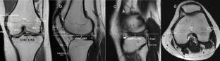 Adductor tubercle as a reliable landmark for knee joint line determination: a comparative radiological study