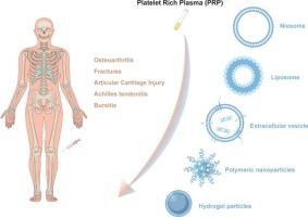 Platelet-rich plasma-contained drug delivery systems to treat orthopedic injuries