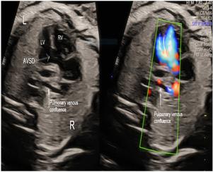Clues on the Three-Vessel View for Fetal Diagnosis of Supracardiac Total Anomalous Pulmonary Venous Connection
