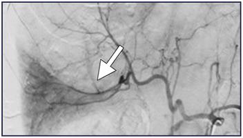Arterial Injury from Transjugular Liver Biopsy with Delayed Hemorrhage