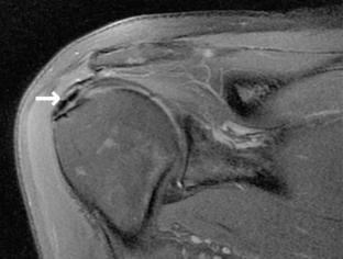 Arthroscopic treatment of calcifying tendinitis of the shoulder: clinical and structural long-term results