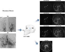 5.0T MRA techniques for evaluating Moyamoya disease: 4D-ASL-MRA vs. 3D-TOF-MRA