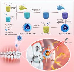 Near-infrared laser-activated PLGA-PDA core-shell nanohybrids for synergistic photothermal antibacterial therapy and sustained ion release in orthodontic white spot lesions prevention