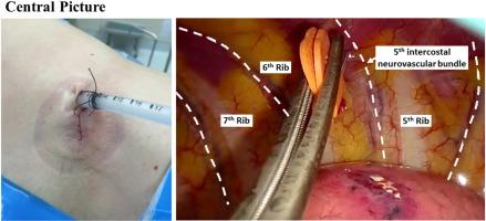 Intercostal nerve block is superior than erector spinae plane block after uniportal video-assisted thoracoscopic surgery: randomized controlled trial