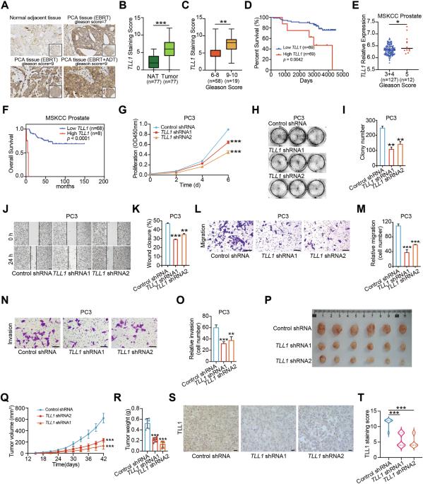 TLL1 knockdown attenuates prostate cancer progression by enhancing antitumor immunity