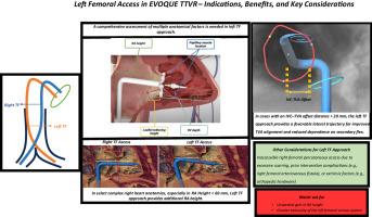 When Right Isn’t Right: Left Femoral Access for EVOQUE Transcatheter Tricuspid Valve Replacement System
