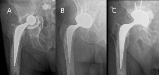 Highly porous 3-D printed tritanium acetabular shell for aseptic revision total hip