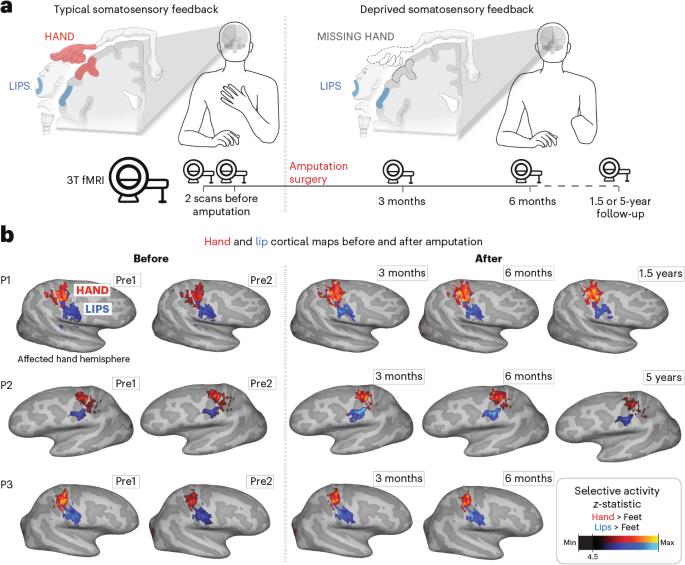 The brain’s body map does not forget lost limbs