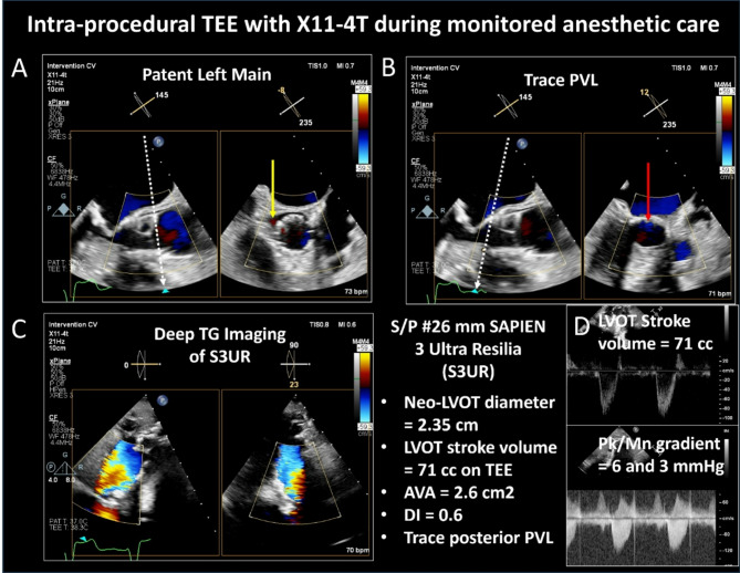 Mini 3D transesophageal probe: technical advances and clinical applications.