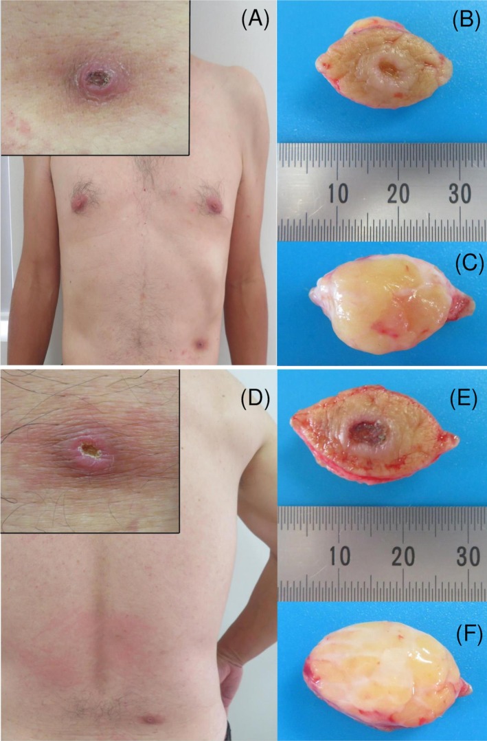 Cutaneous Pseudolymphomas With Identical Clinicopathological Features Induced by Tick Bites at Two Separate Sites.