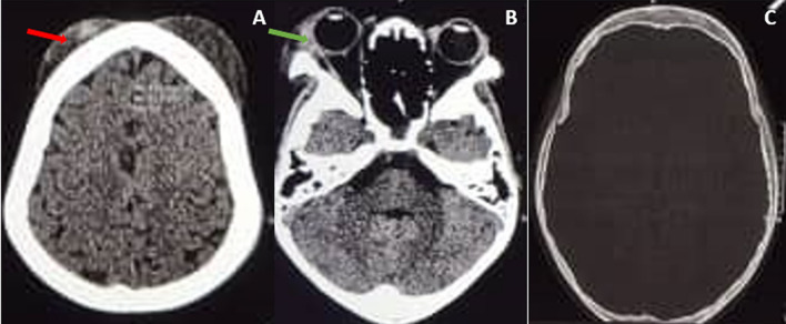 Acute soft head syndrome and orbital compression syndrome in a child with sickle cell disease: a case report.