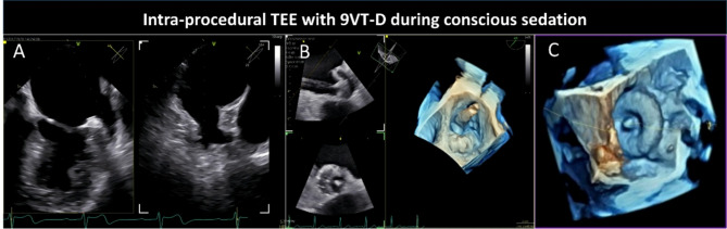 Mini 3D transesophageal probe: technical advances and clinical applications.